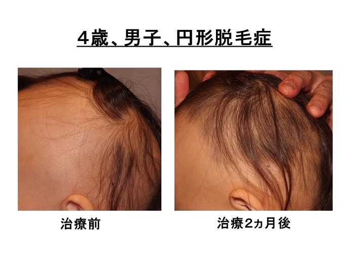 円形脱毛症　病院""